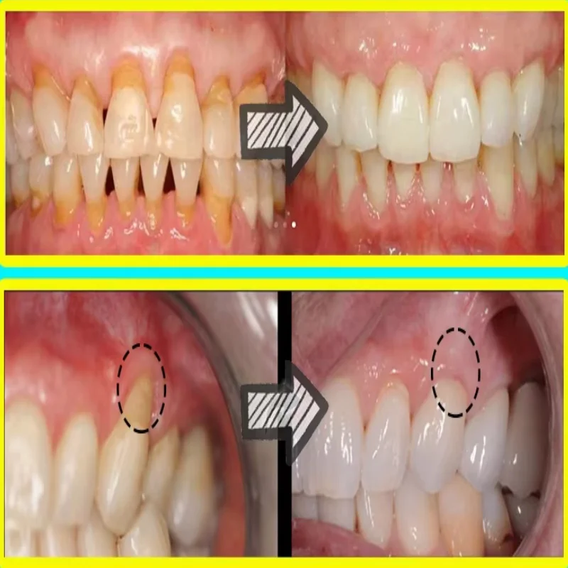 Quickly Repair Gum Serum Relie - Teeth Whitening With Baking Soda avaliação e preço