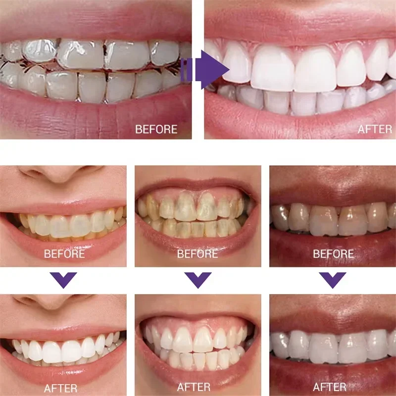 Teeth Cleansing Whitening Toot - Teeth Whitening Korea avaliação e preço